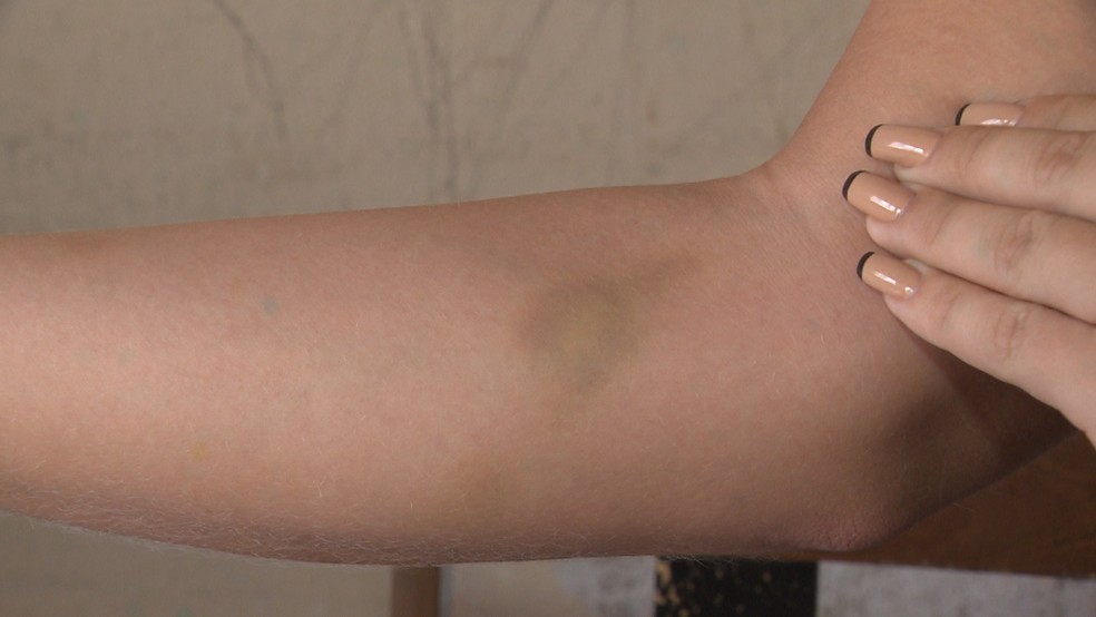 Marca roxa no brasço de mulher que denunciou ter sido agredida com socos por motorista de aplicativo em Campina Grande — Foto: TV Paraíba/Reprodução