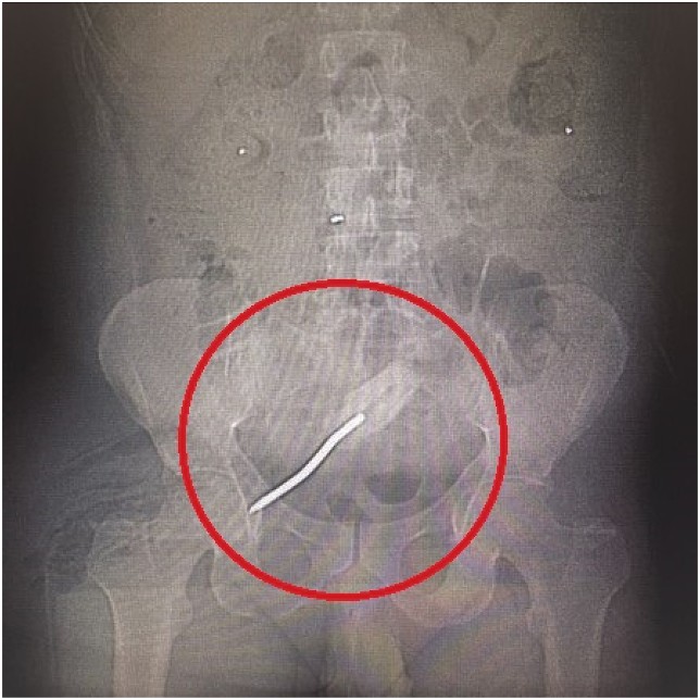 Homem passa por cirurgia após inserir chave de fenda de 20 cm no reto (Foto: Annals of Medicine and Surgery)