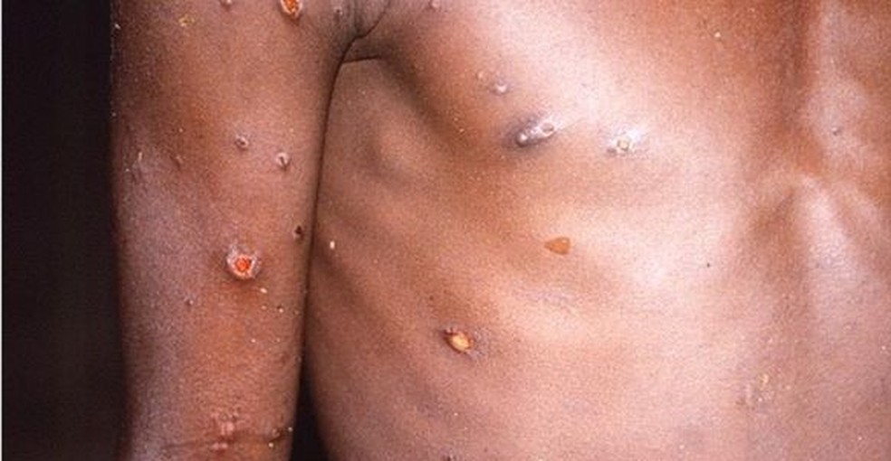 Varíola dos macacos provoca erupções na pele — Foto: CDC
