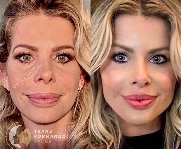 Cirurgião mostra antes e depois de preenchimento labial de Karina