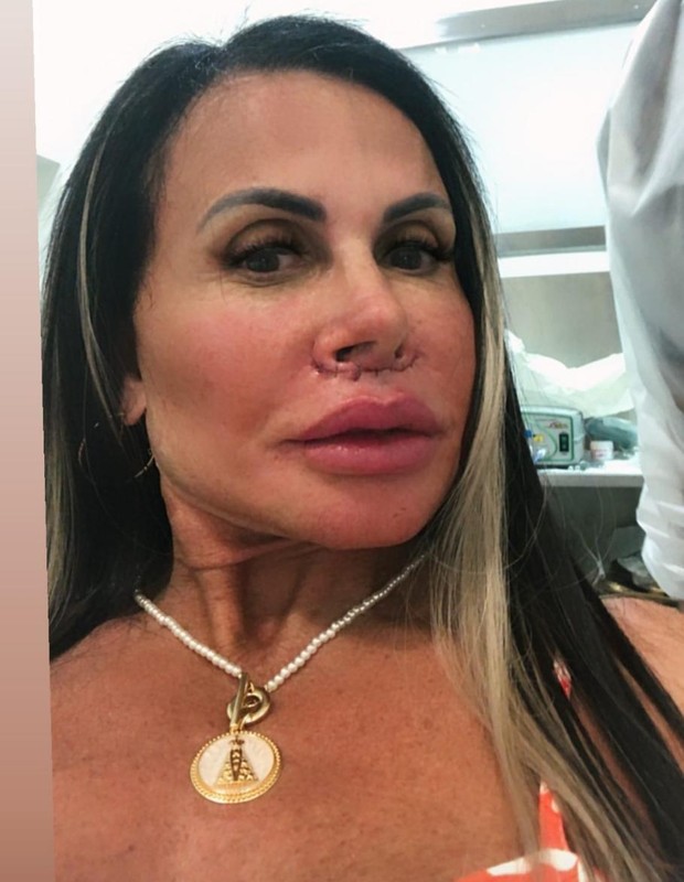 Gretchen após o lip lift (Foto: Reprodução/Instagram)
