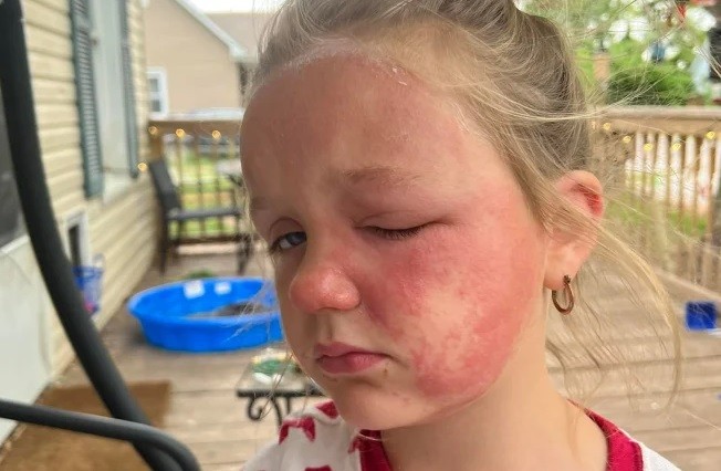 A menina de 6 anos ficou toda inchada ao ter contato com a planta tóxica (Foto: Reprodução/ The Sun)