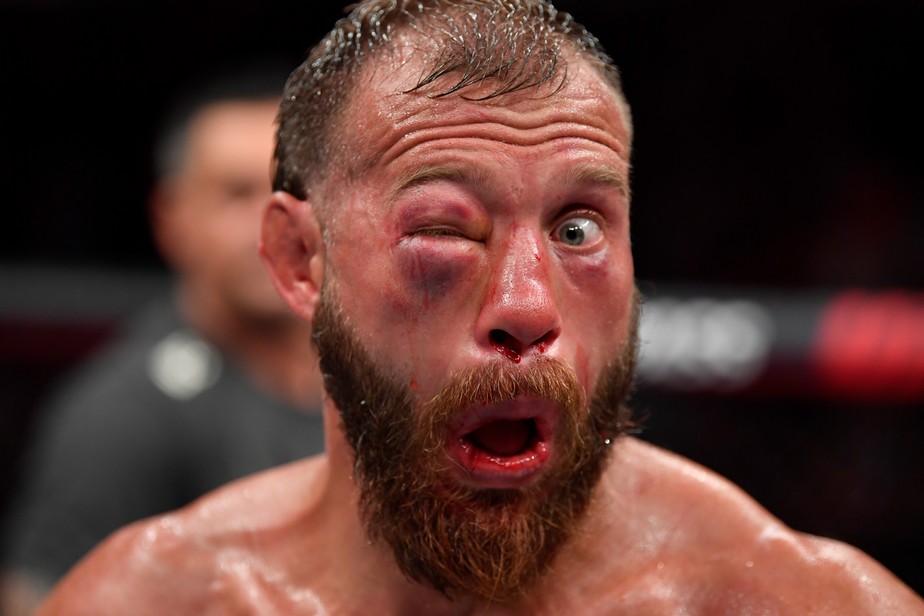 Cerrone Deixa Octogono Com Inchaco Gigante No Olho E E Levado Para Hospital Veja Fotos Combate Sportv