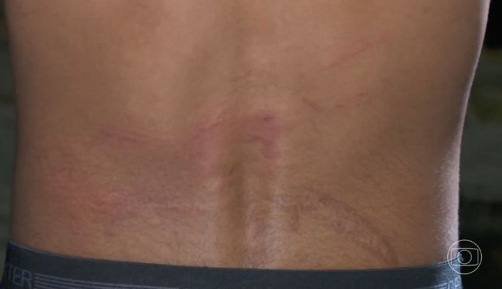 Marcas de agressão no adolescente de 17 anos, em SP — Foto: Reprodução/TV Globo