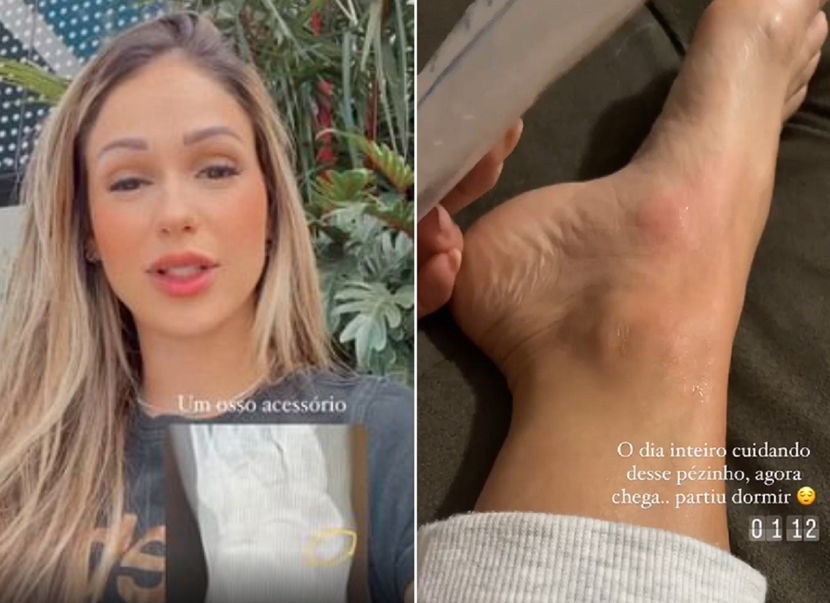 Carla Bruno sofre lesão no pé e descobre osso acessório (Foto: Reprodução/Instagram)