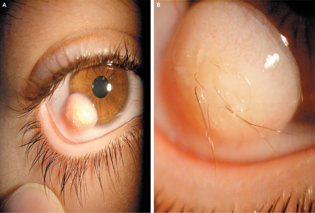 Tumor com pelos identificado no olho de paciente (Foto: Reprodução/"The New England Journal of Medicine")