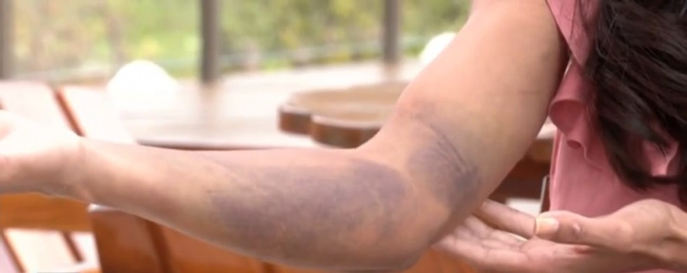 Mayana foi picada três vezes por uma jararaca durante enxurrada em Correia de Almeida, Barbacena (MG) — Foto: TV Integração/Reprodução