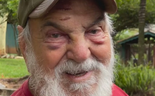 Aos 91, Lima Duarte leva tombo e fica com olhos roxos