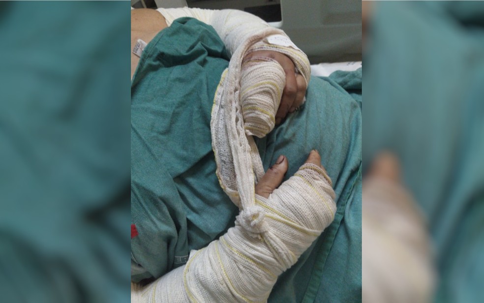 Adriana teve os dois braços fraturados e teve de passar por cirurgia nos membros — Foto: Arquivo pessoal