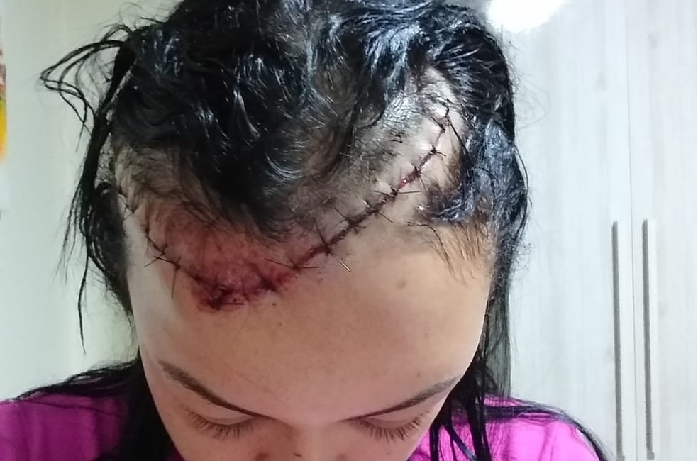 Rafaele Christina Melo de Almeida foi levada para o hospital e levou 40 pontos na cabeça — Foto: Arquivo pessoal