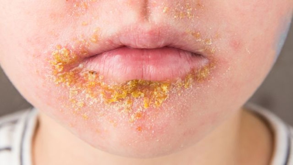 Impetigo — Foto: Getty Images via BBC