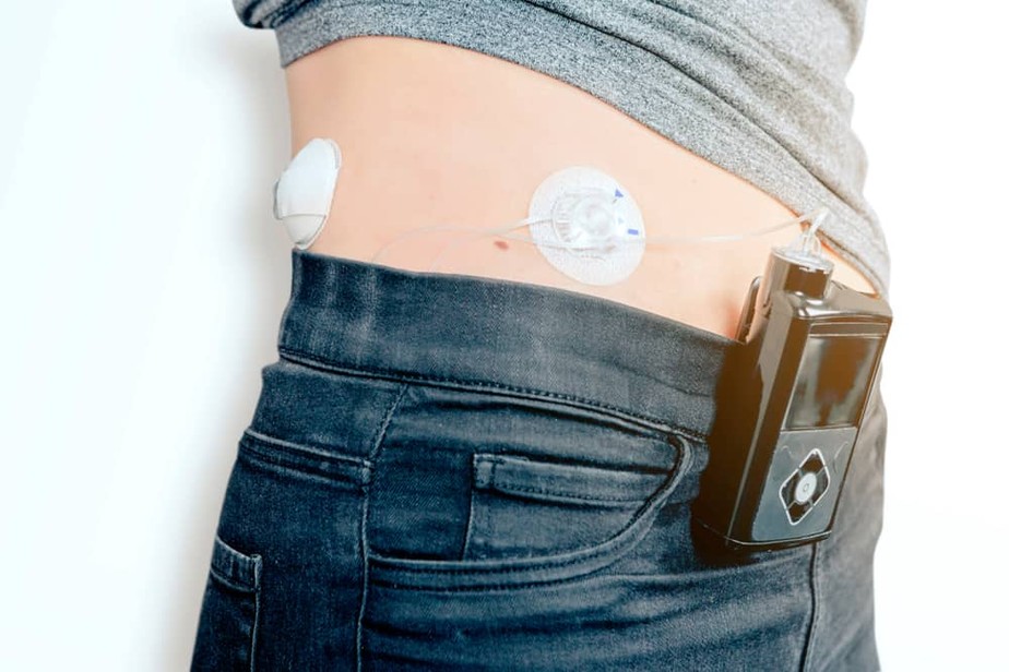 Um sistema de pâncreas artificial usa um monitor contínuo de glicose, uma bomba de insulina e um programa em um smartphone.