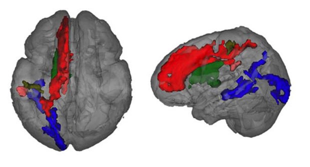 Scan mostra o desenvolvimento da mielina no cérebro de uma criança. (Foto: BBC)
