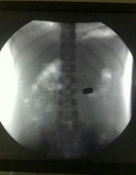 Raio-X do tórax de Letícia em que é possível identificar a peça à direita da coluna vertebral (Foto: Arquivo pessoal)