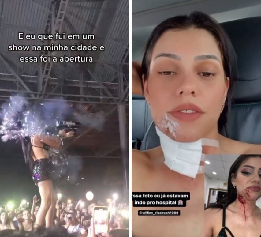 DJ Flavinha reclama de crises de dor de cabeça após disparar canhão de confetes no rosto durante show em SC