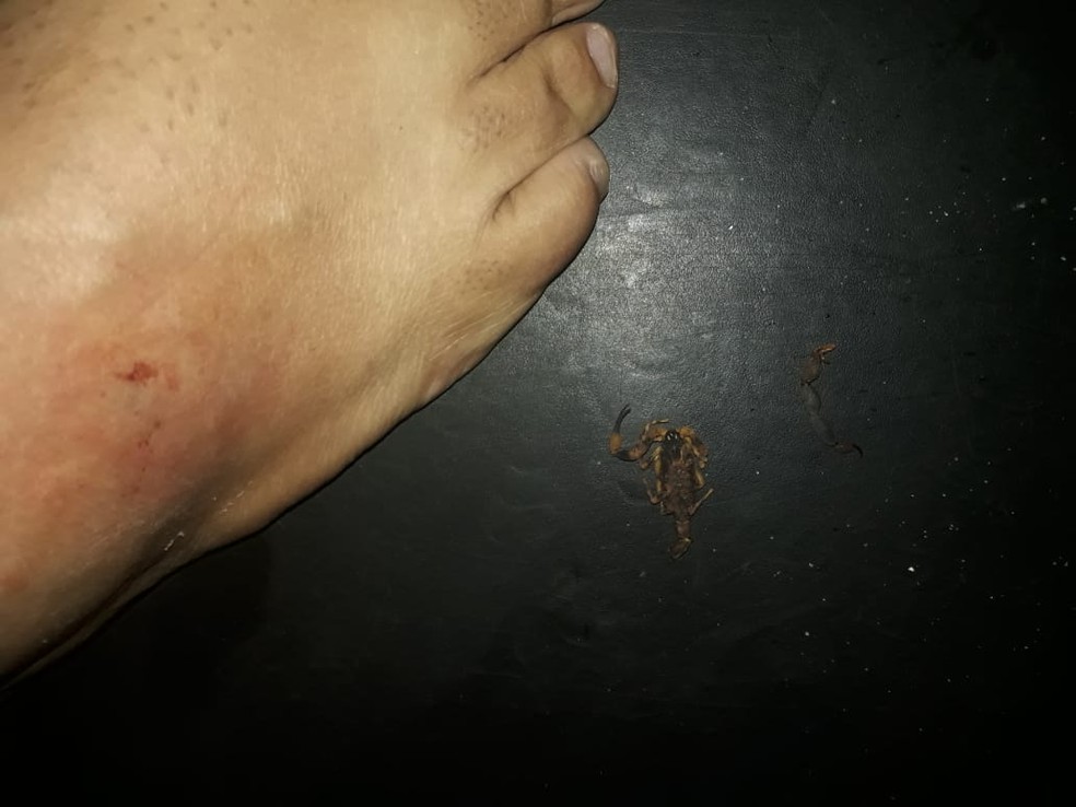 Escorpião picou Luiz Paulo no pé direito.  — Foto: Arquivo pessoal