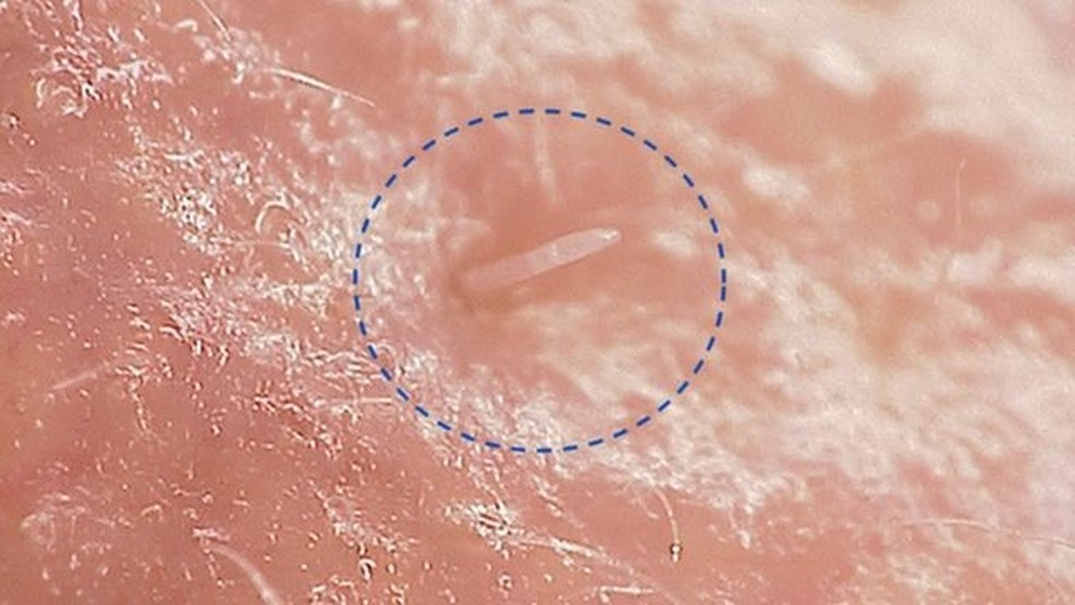 Os ácaros Demodex folliculorum, como os cientistas os chamam, têm apenas 0,3 mm de comprimento — Foto: UNIVERSITY OF READING via BBC