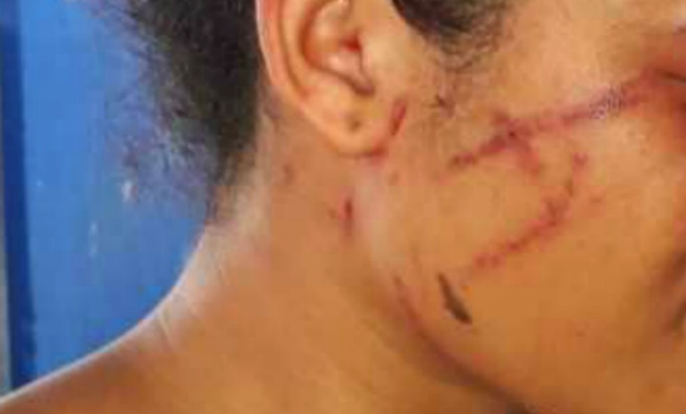 Menina de 13 ficou com rosto cheio de ferimentos â?? Foto: Lenio Cidreira/Site Liberdade News