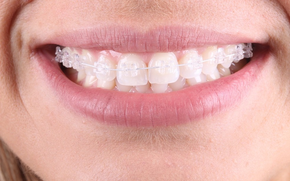 Aparelho Ortodontico Moderno Transforma Sorrisos Ate O Dia Do Casamento Especial Publicitario Na Mosca Eventos G1