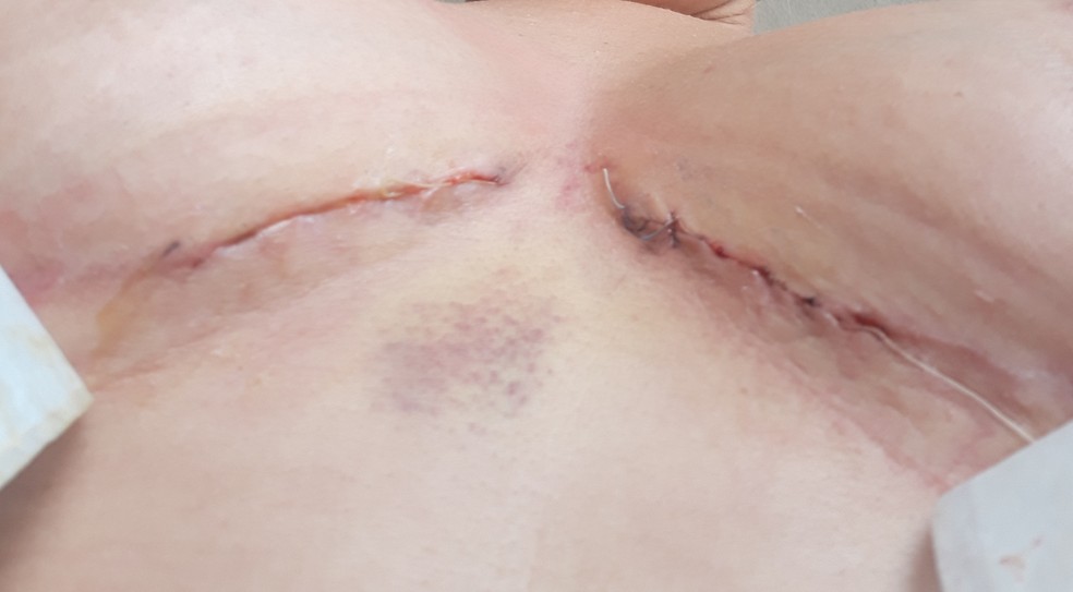 Cicatriz de cirurgia plástica em paciente de médico investigado pela polícia no Distrito Federal — Foto: Arquivo pessoal