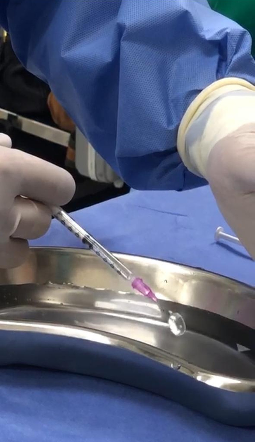 Médico prepara instrumento para cirurgia em feto de seis meses — Foto: Arquivo pessoal