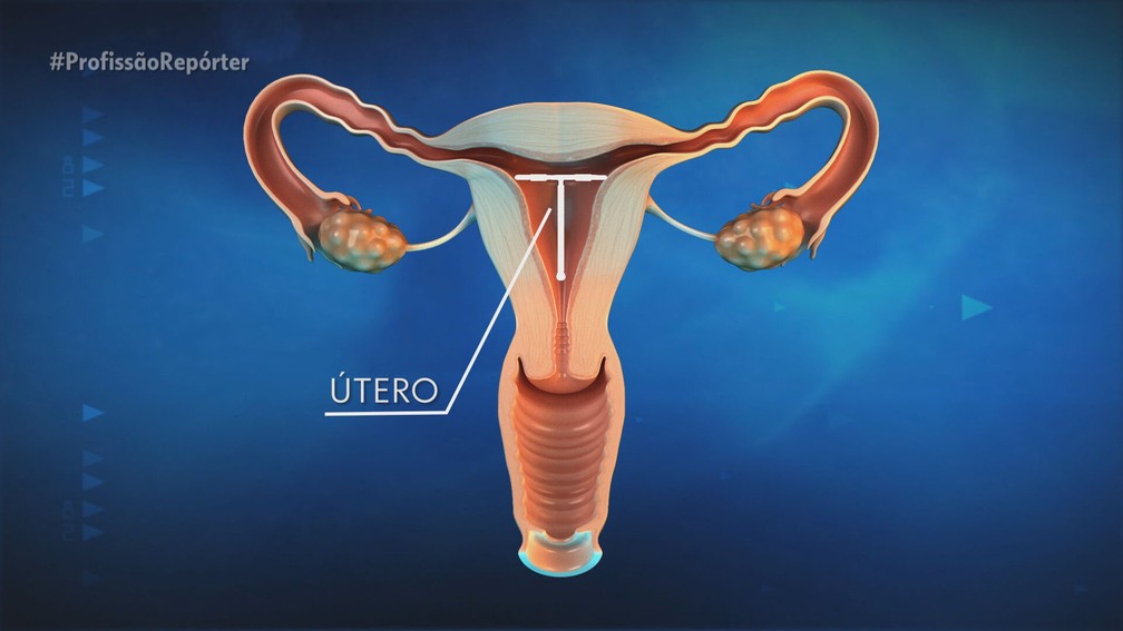 O DIU de cobre é o principal dispositivo intrauterino disponibilizado pelo Sistema Único de Saúde — Foto: Profissão Repórter