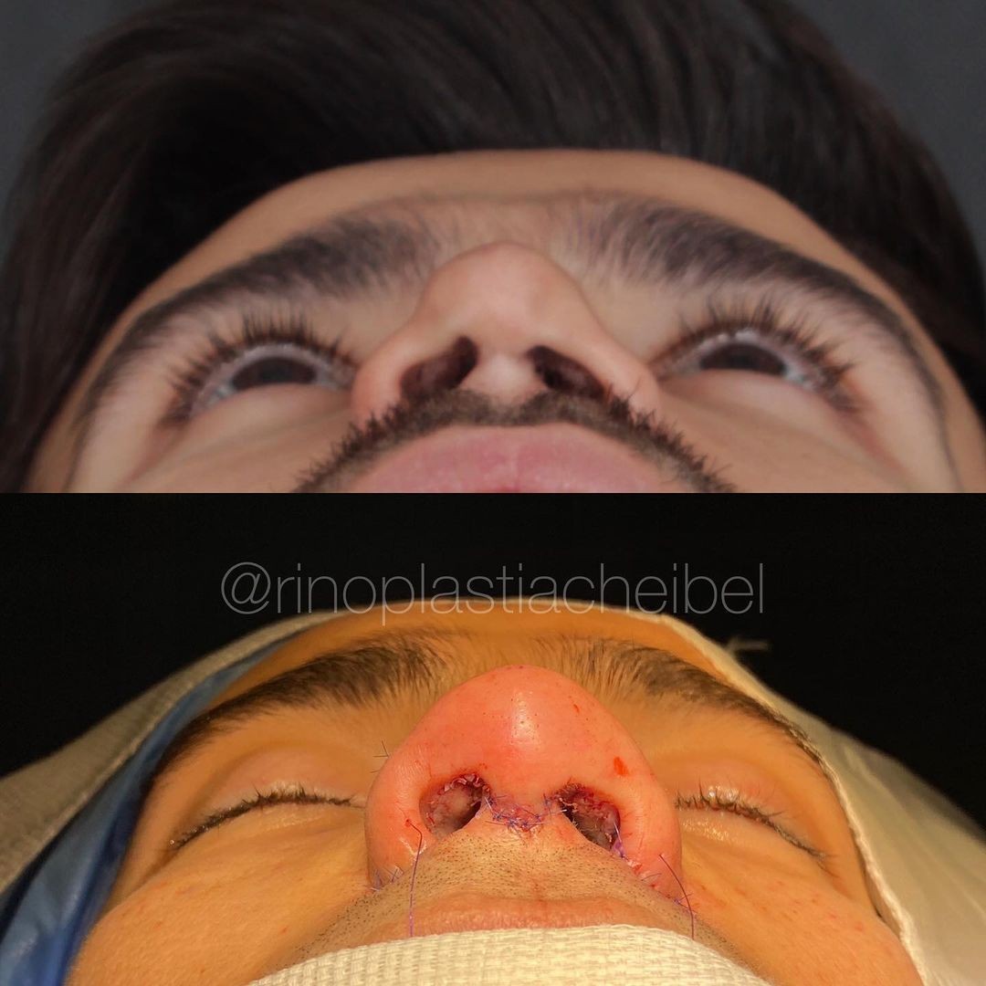Jakelyne e Mariano mostram resultado de rinoplastia (Foto: Reprodução/Instagram) Jakelyne e Mariano mostram resultado de rinoplastia (Foto: Reprodução/Instagram)