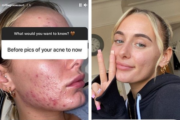 Millie Court, 24, detalha luta contra as acnes (Foto: Reprodução/Instagram)