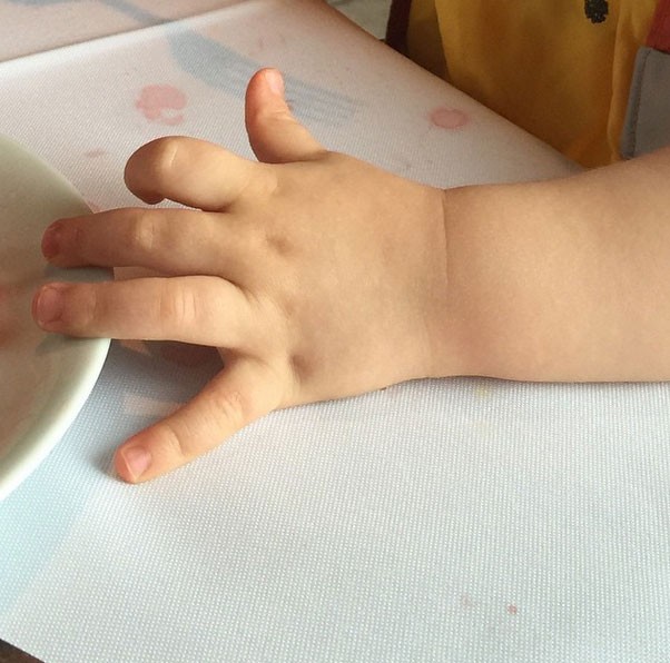 A mãozinha de Miguel, que se machucou depois de um tombo na escola (Foto: Reprodução/ Instagram)