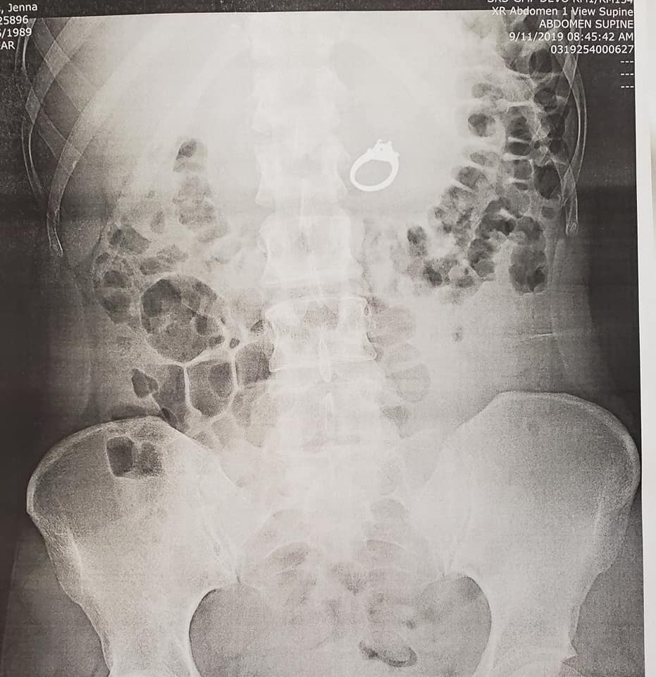 Médicos pediram um exame de raio-x para descobrirem se a moça, de fato, engolira o anel (Foto: Reprodução Facebook/Jenna Evans)
