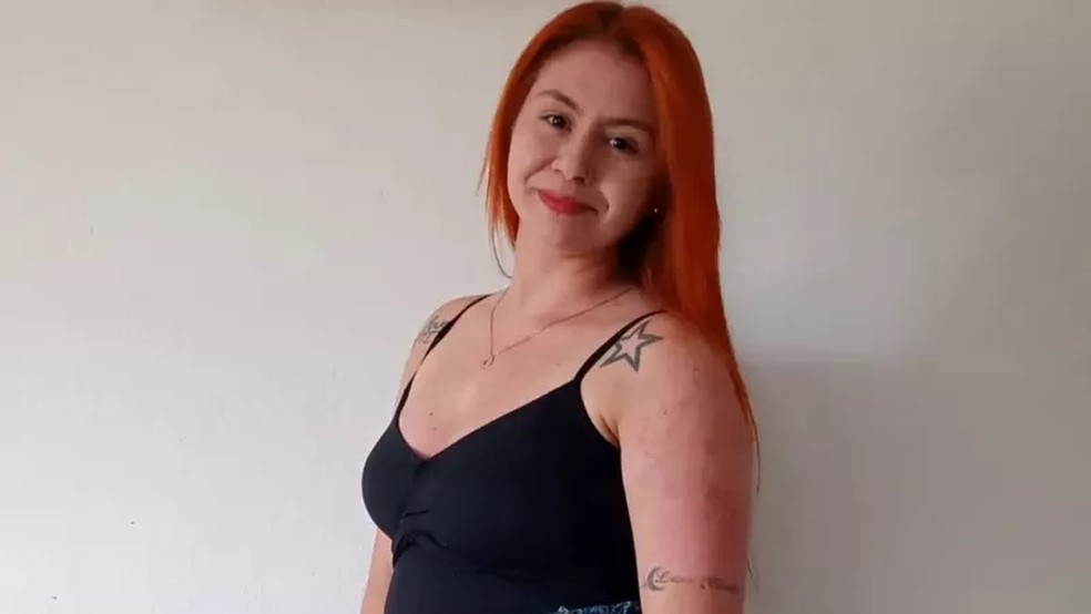 Pele de Caroline começou a melhorar após o uso de medicamento destinado a casos moderados e graves. — Foto: Arquivo pessoal via BBC