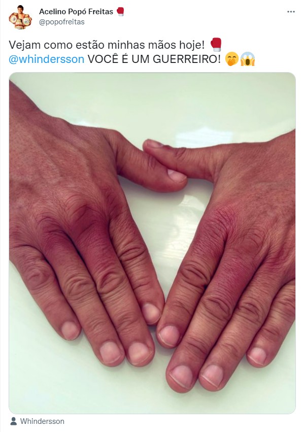 Popó mostra resultado das mãos após luta contra Whindersson Nunes (Foto: Twitter/Reprodução)
