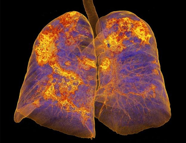 BBC - Imagem dos pulmões de uma pessoa infectada mostra áreas com pneumonia (Foto: SPL)