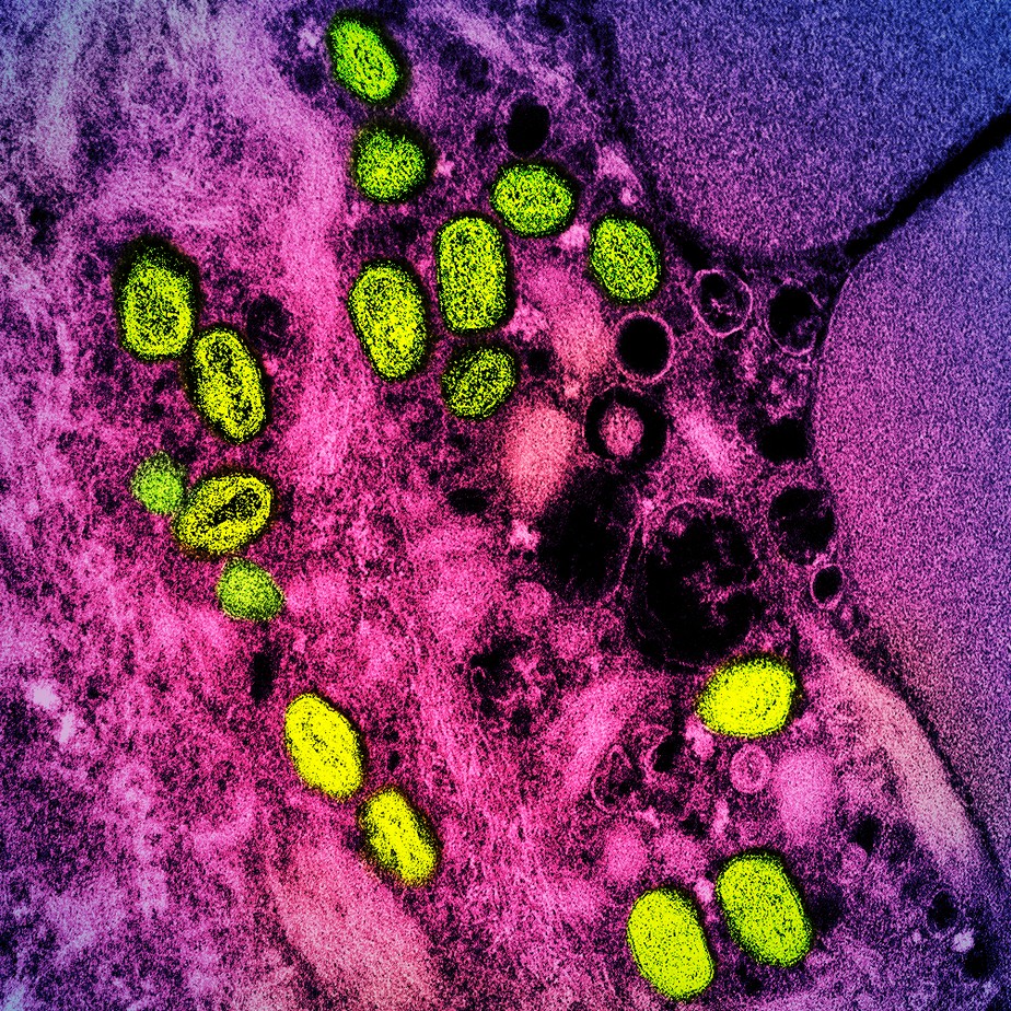 Micrografia eletrônica de transmissão colorida de partículas do vírus da varíola dos macacos (amarelo) encontradas dentro de uma célula infectada (rosa), cultivadas em laboratório.