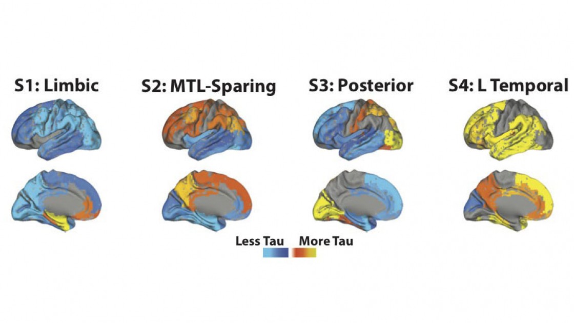 Acima, representação de como a proteína tau se espalha pelo cérebro nos quatro subtipos do Alzheimer identificados pelos pesquisadores (Foto: Jacob Vogel)