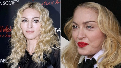 Madonna com pequenas plásticas em 2008 e em 2014, no Grammy, inchada e completamente diferente 