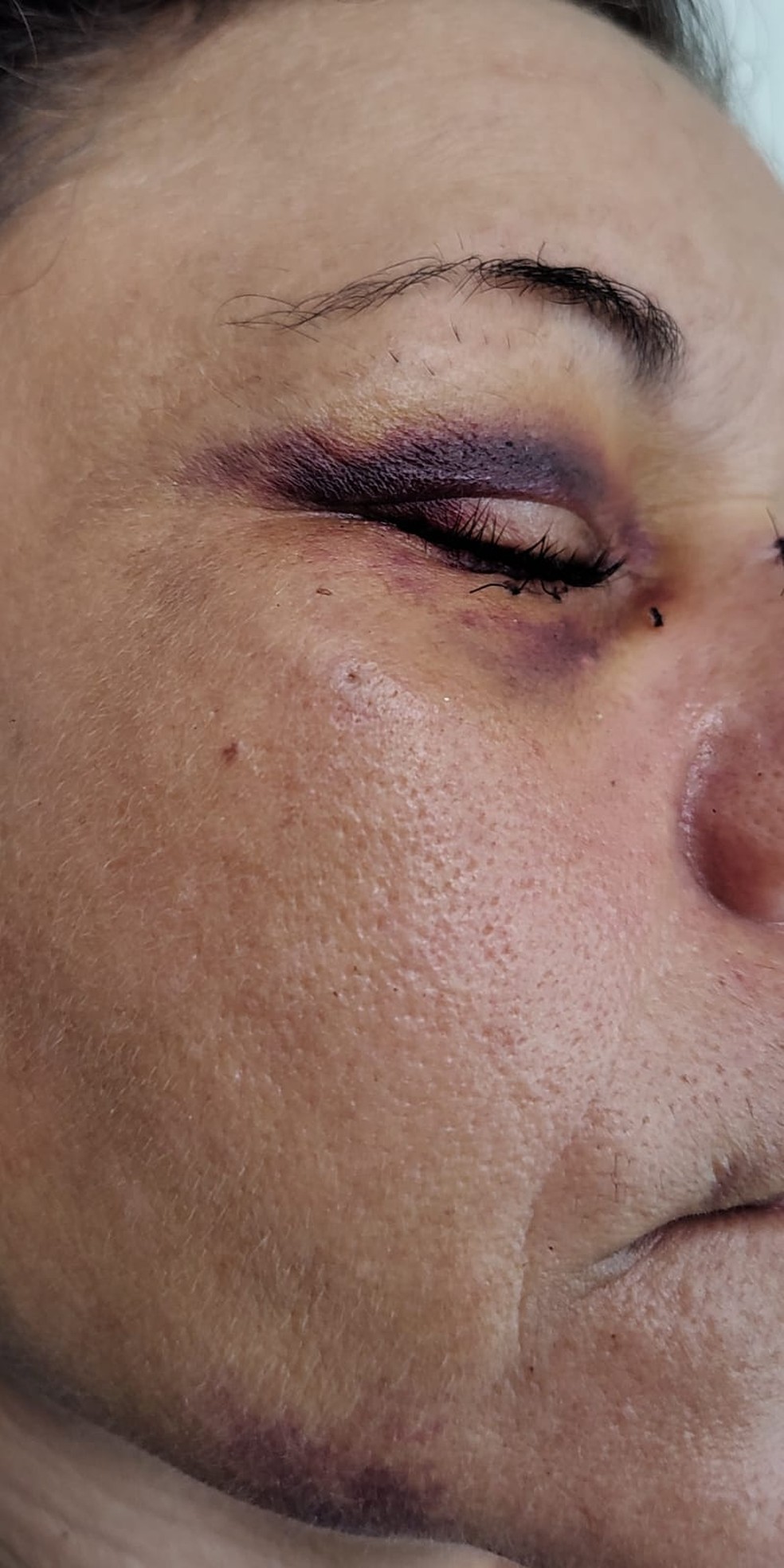 Vítima ficou com o olho roxo e marcas da no queixo — Foto: Aline Nascimento/g1