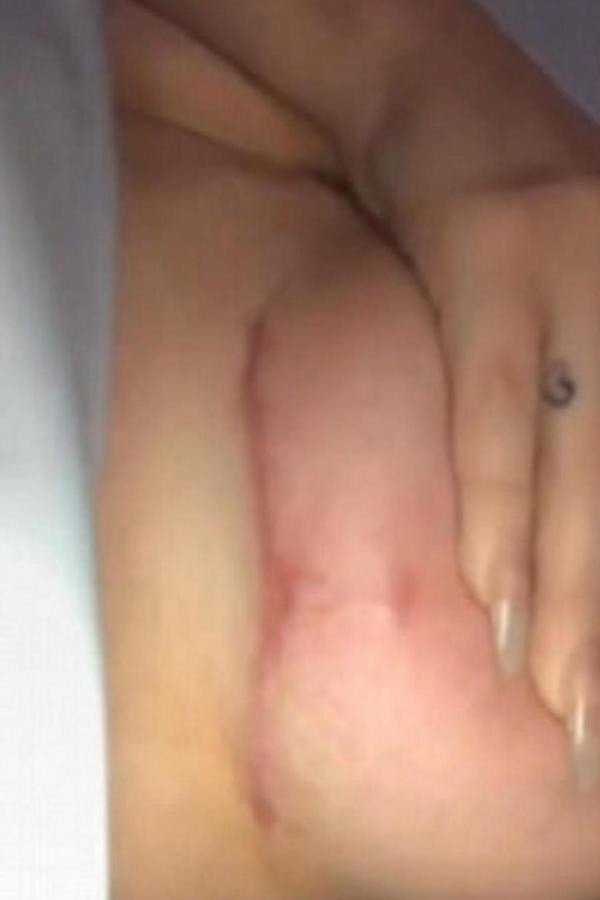 A cicatriz no seio da celebridade Chloe Ferry (Foto: Snapchat)