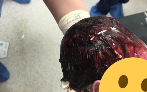 Resultado de imagem para Foto de bebê com DIU enroscado nos cabelos ao nascer viraliza