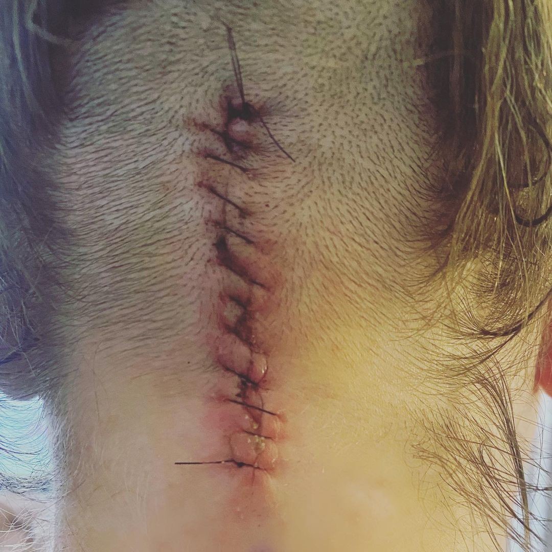 Cicatriz na cabeça de Kirsten Storms (Foto: Reprodução/Instagram)