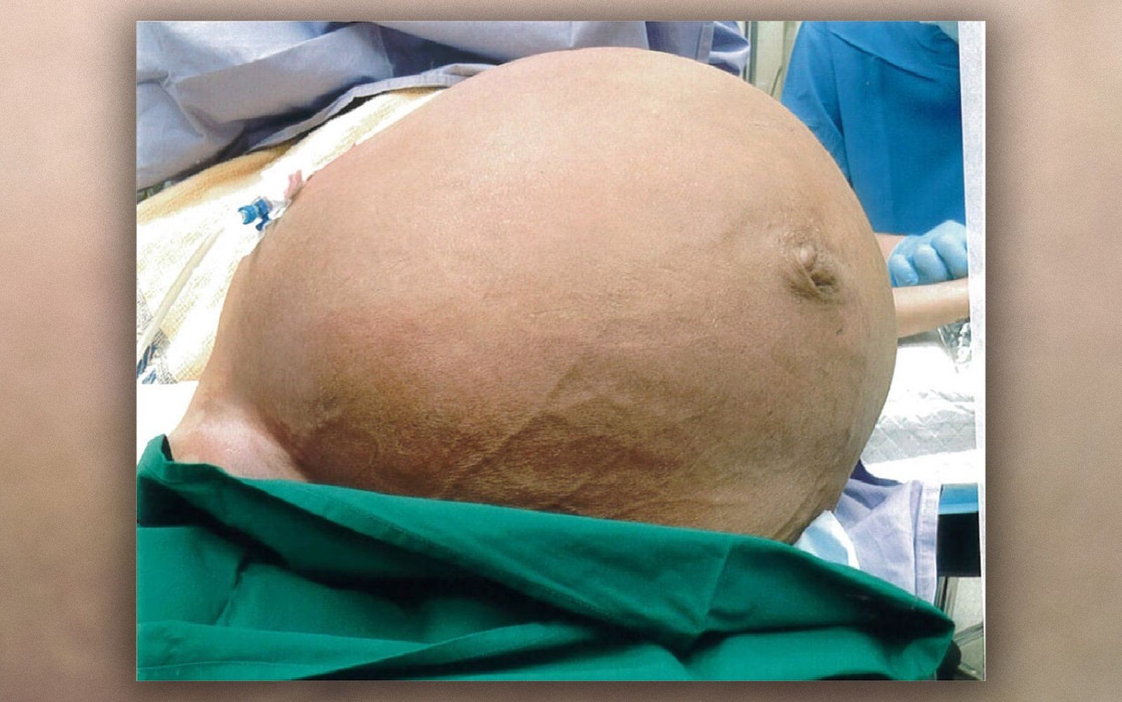 Tumor uterino tinha 25 centímetros de comprimento (Foto: BMJ Case Reports 2018)