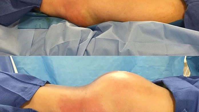 Cirurgia pra ter um "bumbum brasileiro" cresce nos EUA e especialistas veem  riscos | Beleza | Glamour