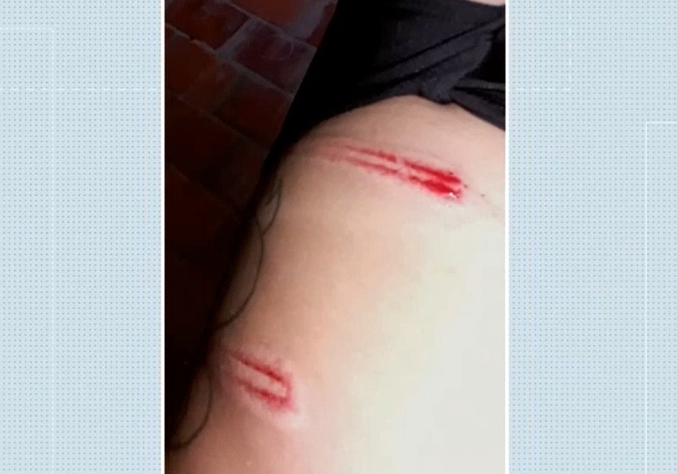 Garota agredida por policiais em Fortaleza exibe marcas de ferimentos — Foto: Reprodução/TV Verdes Mares