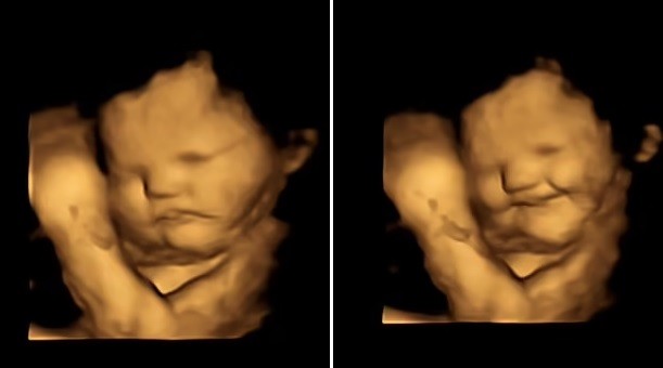 O estudo registrou a reação de bebês no útero, de acordo com os alimentos ingeridos pelas mães. À esquerda, bebê com expressão neutra, à direita, bebê sorrindo (Foto: Reprodução/ Daily Mail)