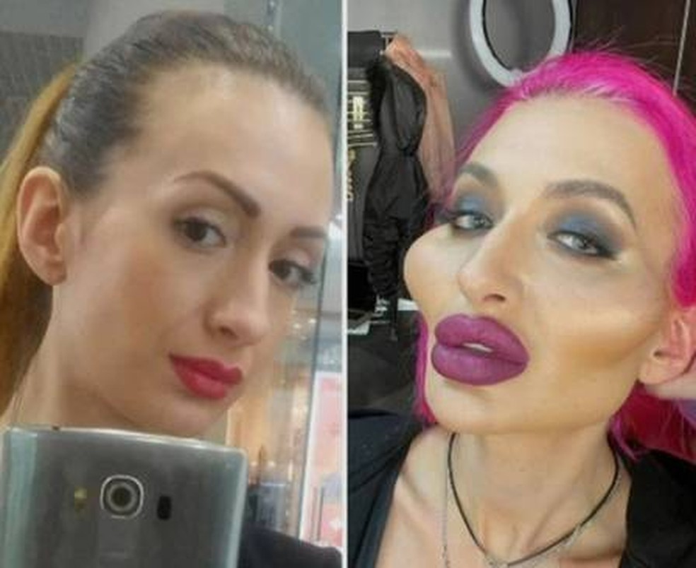 Anastasia Pokreshchuk, a dona das 'maiores maças do rosto do mundo': antes e depois — Foto: Reprodução