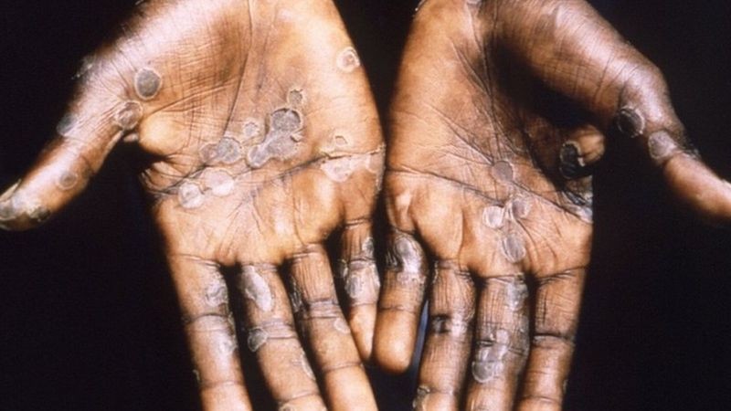 Mãos com varíola dos macacos (Foto: CDC)