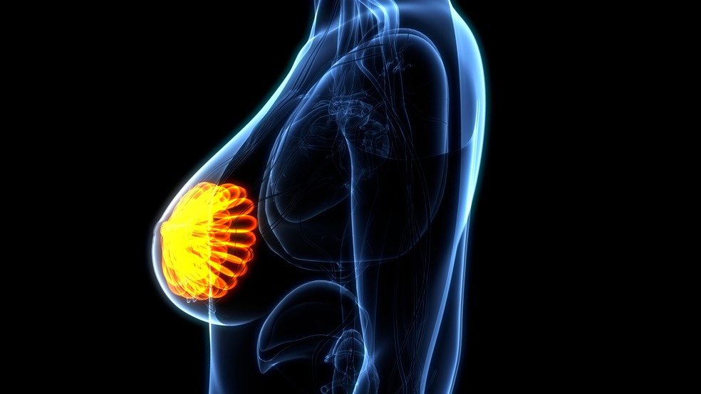 Imagem anatômica do câncer de mama.  — Foto: iStock