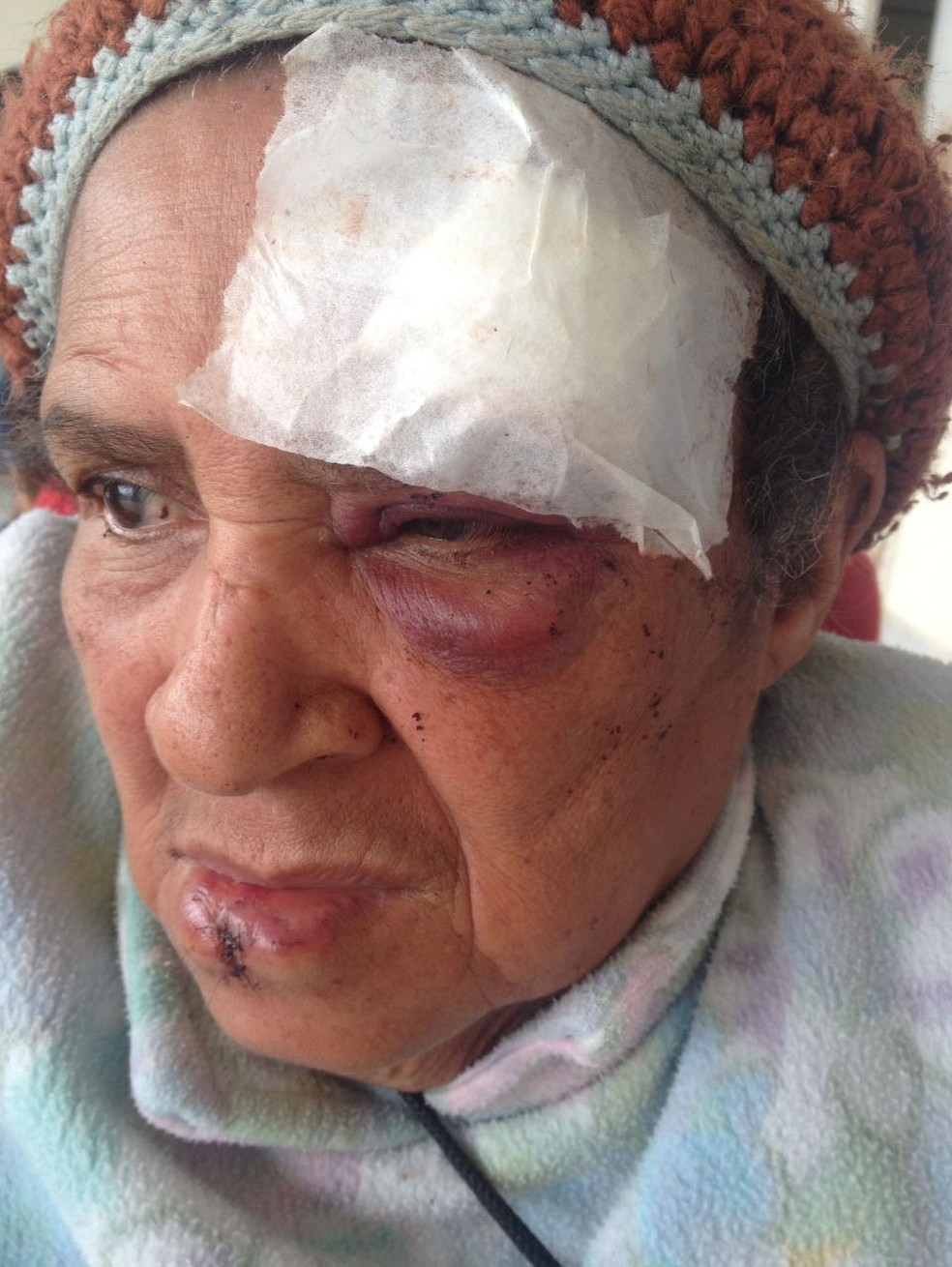 Maria da Conceição, de 65 anos, sofreu diversos ferimentos no rosto e precisou levar pontos na testa e na boca (Foto: Arquivo Pessoal)