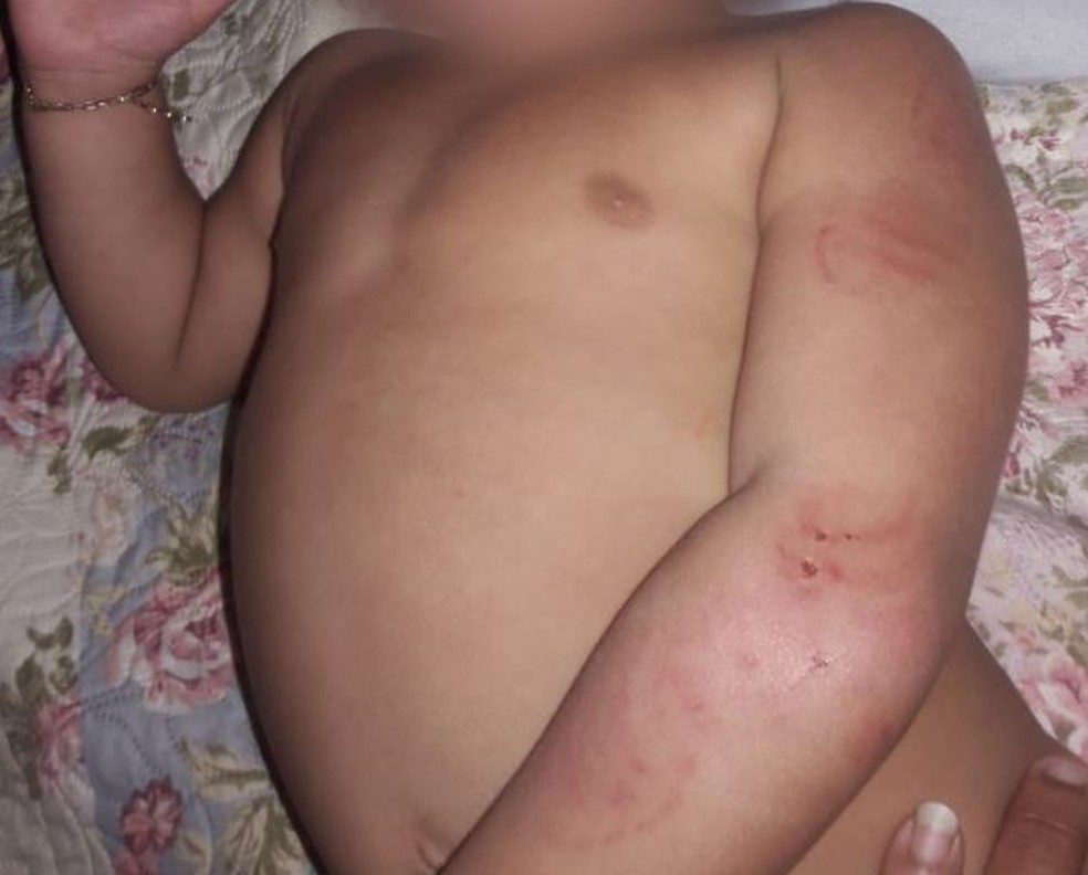 BebÃª teve mordidas dadas por uma crianÃ§a que estava no mesmo ambiente â€” Foto: Arquivo pessoal