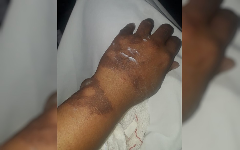 M&atilde;o queimada da mulher que teve fogo ateado a ela &mdash; Foto: Reprodu&ccedil;&atilde;o/TV Anhanguera